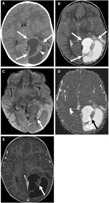 Classification and neuroimaging of ependymal tumors